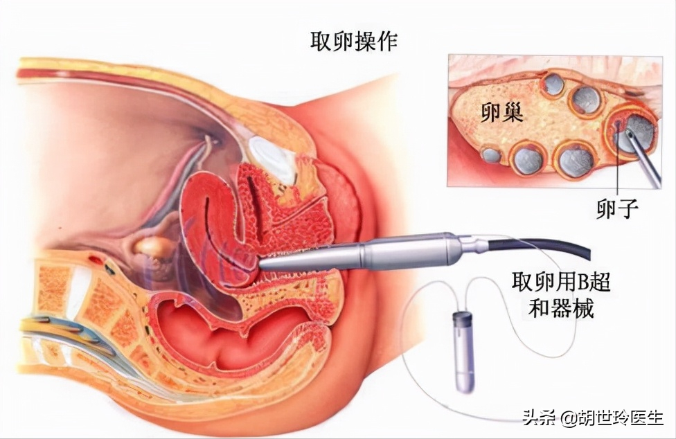香港验血查男女是国内的无创吗,关于试管婴儿的全过程，女性的付出让人心疼